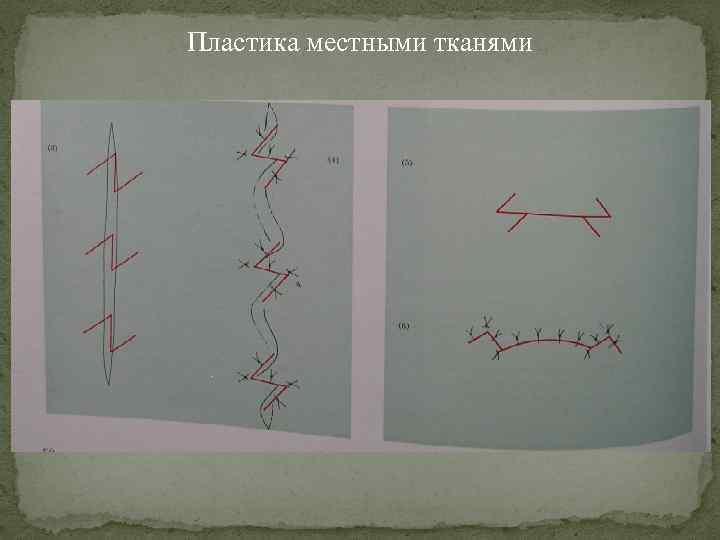 Пластика местными тканями 