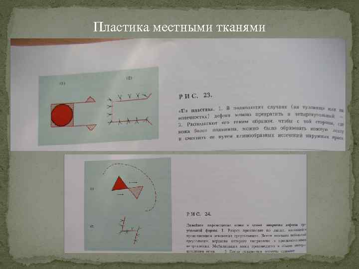 Пластика местными тканями 