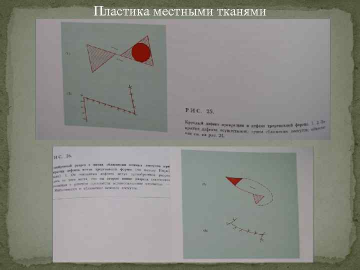 Презентация пластика местными тканями