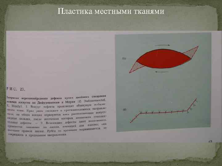 Пластика местными тканями 