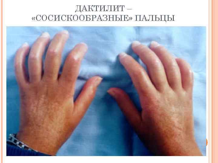 ДАКТИЛИТ – «СОСИСКООБРАЗНЫЕ» ПАЛЬЦЫ 