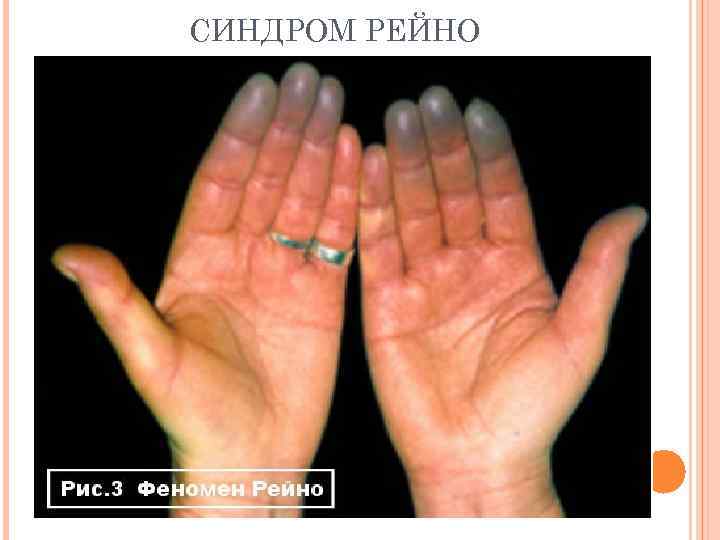 СИНДРОМ РЕЙНО 