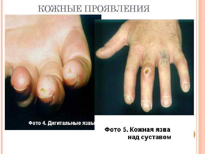 КОЖНЫЕ ПРОЯВЛЕНИЯ 