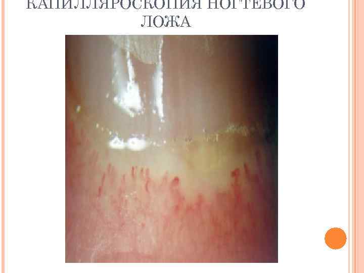 КАПИЛЛЯРОСКОПИЯ НОГТЕВОГО ЛОЖА 