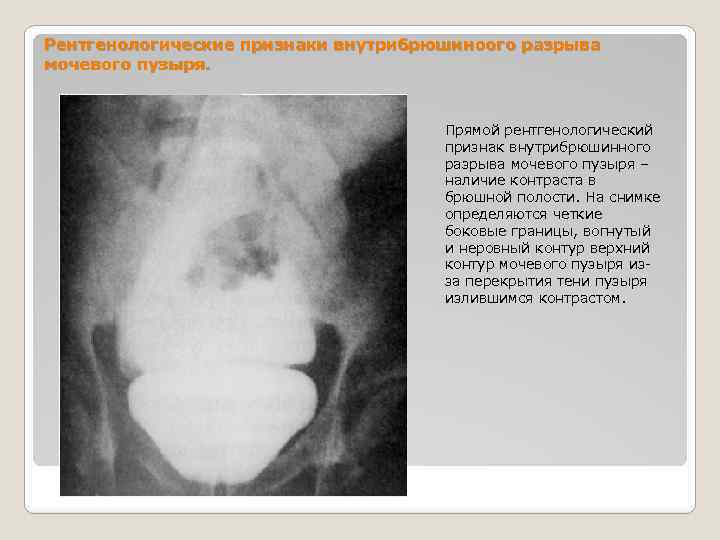 Рентгенологические признаки внутрибрюшиноого разрыва мочевого пузыря. Прямой рентгенологический признак внутрибрюшинного разрыва мочевого пузыря –