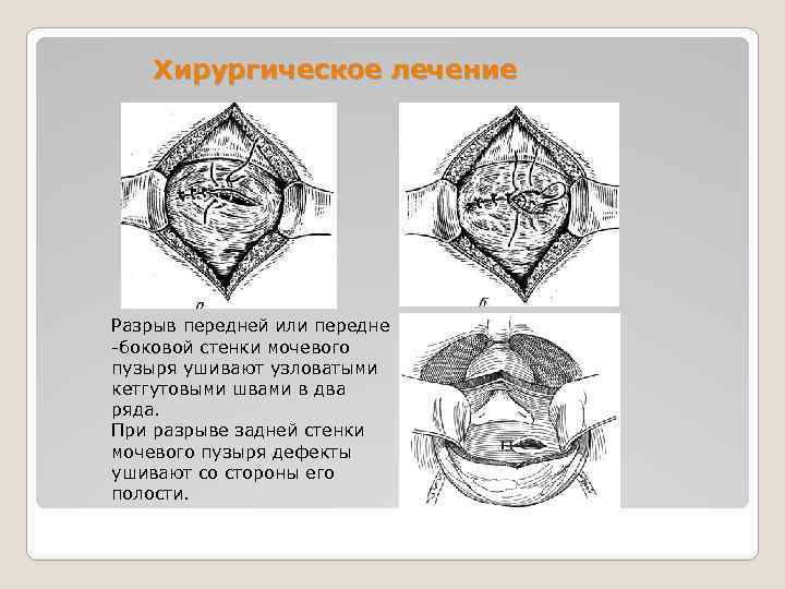 Хирургическое лечение Разрыв передней или передне -боковой стенки мочевого пузыря ушивают узловатыми кетгутовыми швами