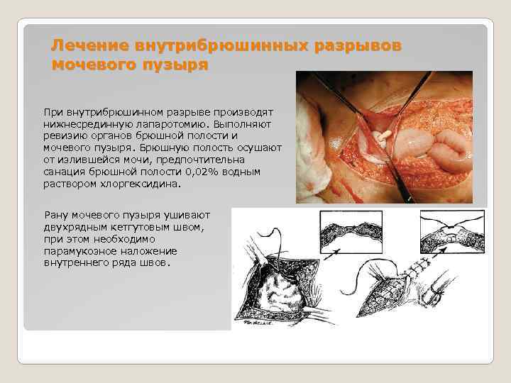 Лечение внутрибрюшинных разрывов мочевого пузыря При внутрибрюшинном разрыве производят нижнесрединную лапаротомию. Выполняют ревизию органов