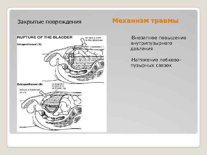 Закрытые повреждения Механизм травмы • Внезапное повышение внутрипузырного давления • Натяжение лобковопузырных связок 