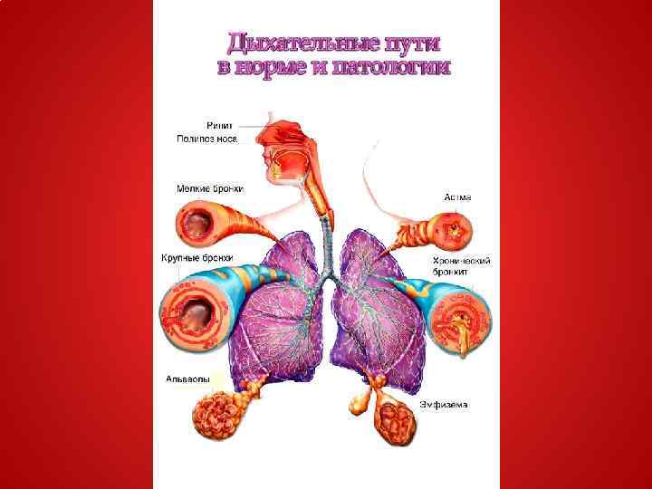 Бронхит на рисунке