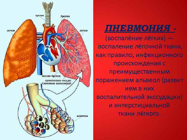 ПНЕВМОНИЯ (воспале ние лёгких) — воспаление лёгочной ткани, как правило, инфекционного происхождения с преимущественным