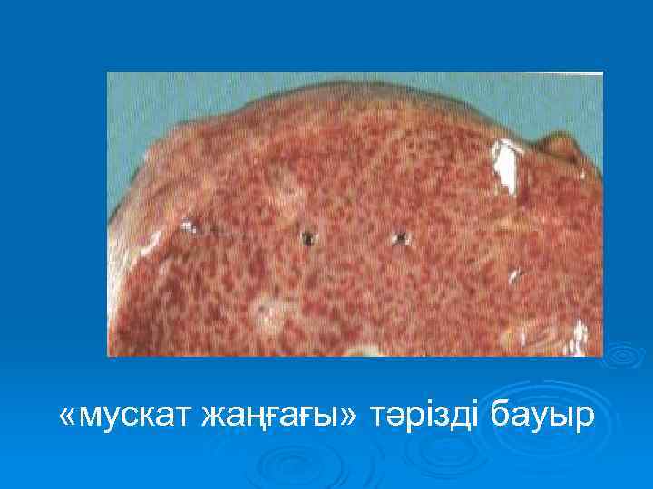  «мускат жаңғағы» тәрізді бауыр 