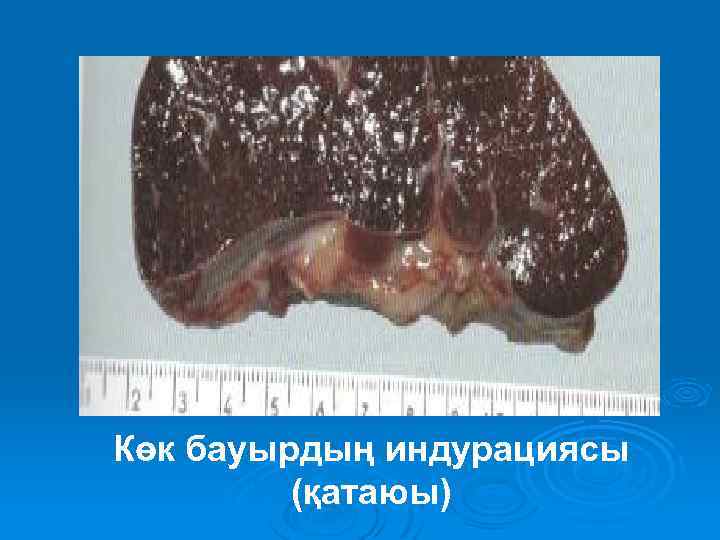 Көк бауырдың индурациясы (қатаюы) 