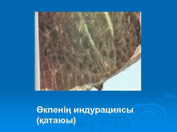 Өкпенің индурациясы (қатаюы) 