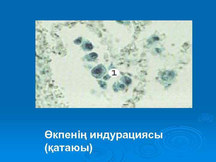 Өкпенің индурациясы (қатаюы) 