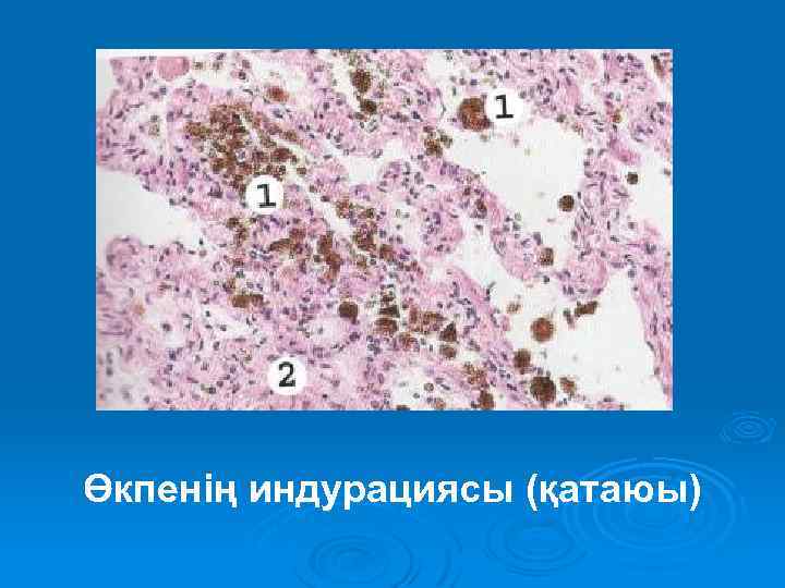 Өкпенің индурациясы (қатаюы) 