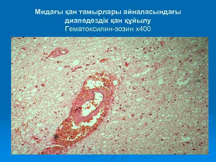 Мидағы қан тамырлары айналасындағы диапедездік қан құйылу Гематоксилин-эозин х400 