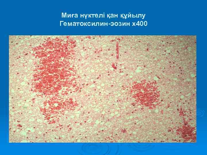 Миға нүктелі қан құйылу Гематоксилин-эозин х400 