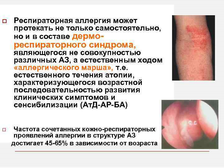 o Респираторная аллергия может протекать не только самостоятельно, но и в составе дермо- респираторного