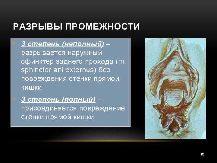 РАЗРЫВЫ ПРОМЕЖНОСТИ • 3 степень (неполный) – разрывается наружный сфинктер заднего прохода (m. sphincter