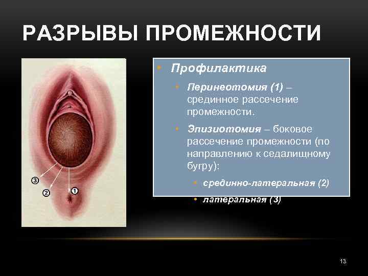 РАЗРЫВЫ ПРОМЕЖНОСТИ • Профилактика • Перинеотомия (1) – срединное рассечение промежности. • Эпизиотомия –