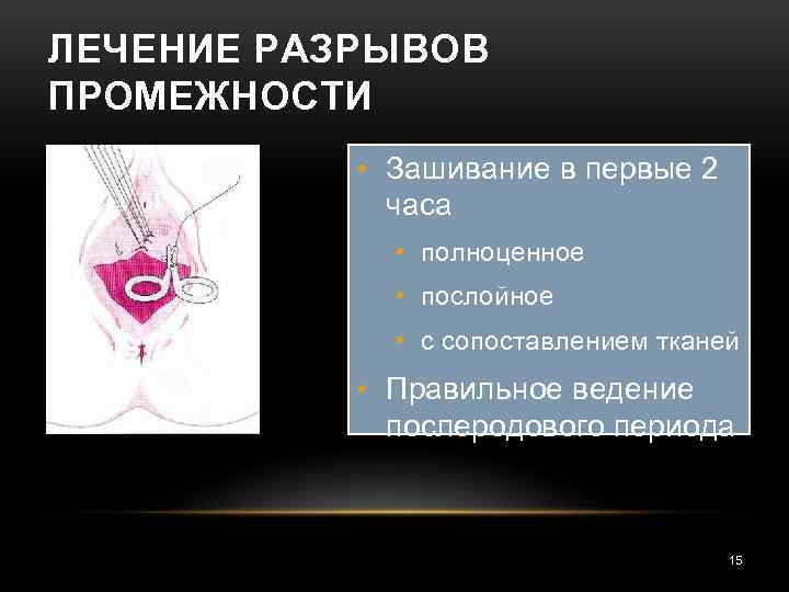 ЛЕЧЕНИЕ РАЗРЫВОВ ПРОМЕЖНОСТИ • Зашивание в первые 2 часа • полноценное • послойное •