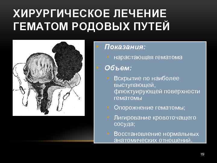 ХИРУРГИЧЕСКОЕ ЛЕЧЕНИЕ ГЕМАТОМ РОДОВЫХ ПУТЕЙ • Показания: • нарастающая гематома • Объем: • Вскрытие