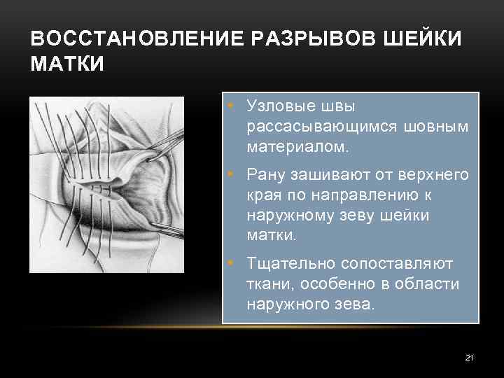 ВОССТАНОВЛЕНИЕ РАЗРЫВОВ ШЕЙКИ МАТКИ • Узловые швы рассасывающимся шовным материалом. • Рану зашивают от