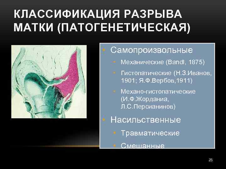 КЛАССИФИКАЦИЯ РАЗРЫВА МАТКИ (ПАТОГЕНЕТИЧЕСКАЯ) • Самопроизвольные • Механические (Bandl, 1875) • Гистопатические (Н. З.