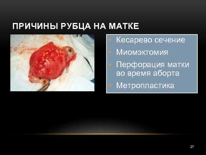 ПРИЧИНЫ РУБЦА НА МАТКЕ • Кесарево сечение • Миомэктомия • Перфорация матки во время