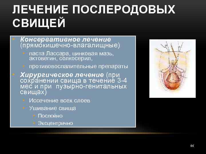 ЛЕЧЕНИЕ ПОСЛЕРОДОВЫХ СВИЩЕЙ • Консервативное лечение (прямокишечно-влагалищные) • паста Лассара, цинковая мазь, актовегин, солкосерил,