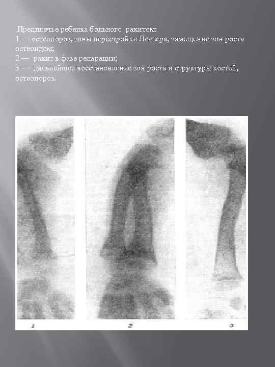  Предплечье ребенка больного рахитом: 1 — остеопороз, зоны перестройки Лоозера, замещение зон роста
