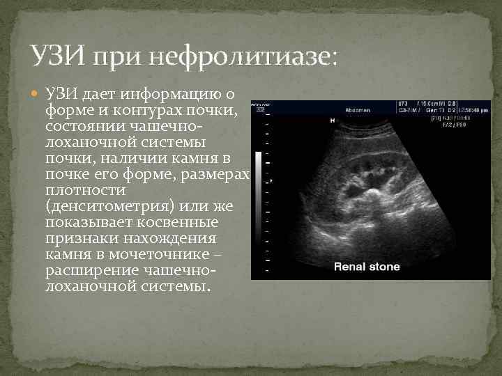 УЗИ при нефролитиазе: УЗИ дает информацию о форме и контурах почки, состоянии чашечнолоханочной системы