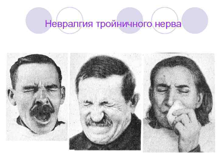 Невралгия тройничного нерва 