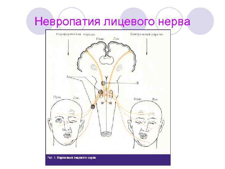 Невропатия лицевого нерва 