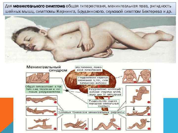 Для менингеального симптома общая гиперестезия, менингеальная поза, ригидность шейных мышц, симптомы Кернинга, Брудзинского, скуловой