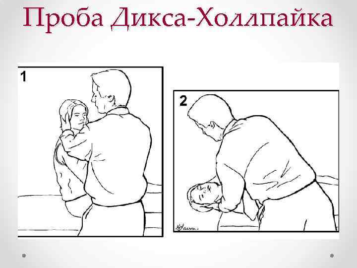 Проба Дикса-Холлпайка 