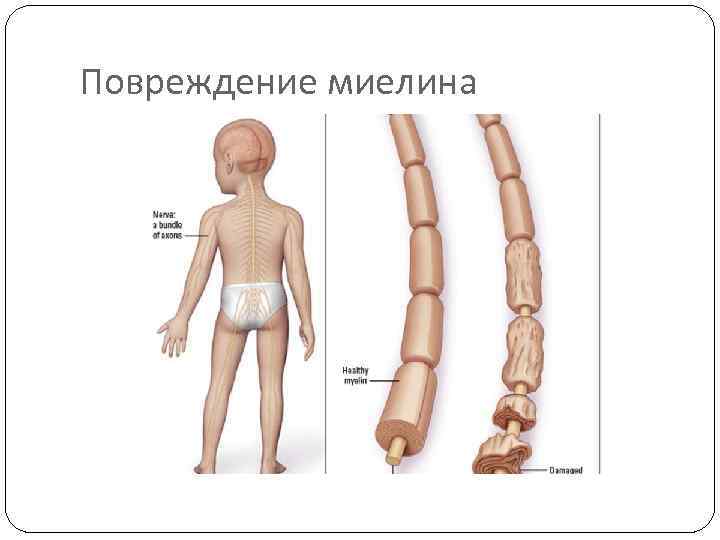 Повреждение миелина 