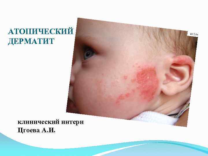 АТОПИЧЕСКИЙ ДЕРМАТИТ клинический интерн Цгоева А. И. 