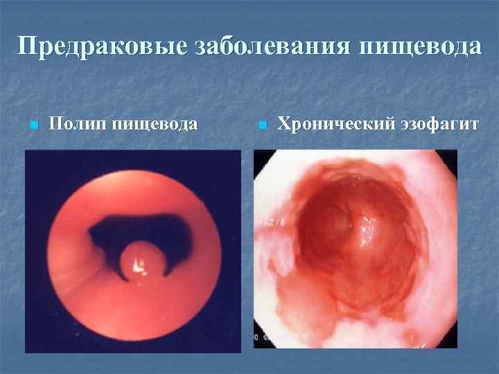 Предраковые заболевания пищевода n Полип пищевода n Хронический эзофагит 