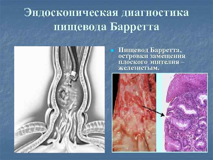 Эндоскопическая диагностика пищевода Барретта n Пищевод Барретта, островки замещения плоского эпителия – железистым. 