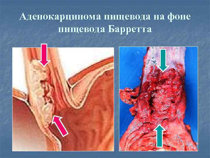 Аденокарцинома пищевода на фоне пищевода Барретта 