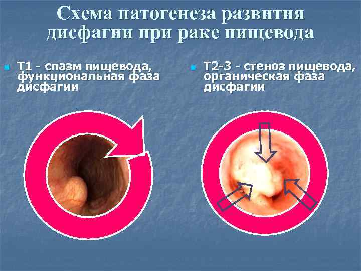 Схема патогенеза развития дисфагии при раке пищевода n T 1 - cпазм пищевода, функциональная