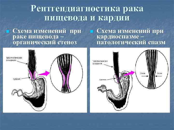 Рентгендиагностика рака пищевода и кардии n Схема изменений при раке пищевода – органический стеноз