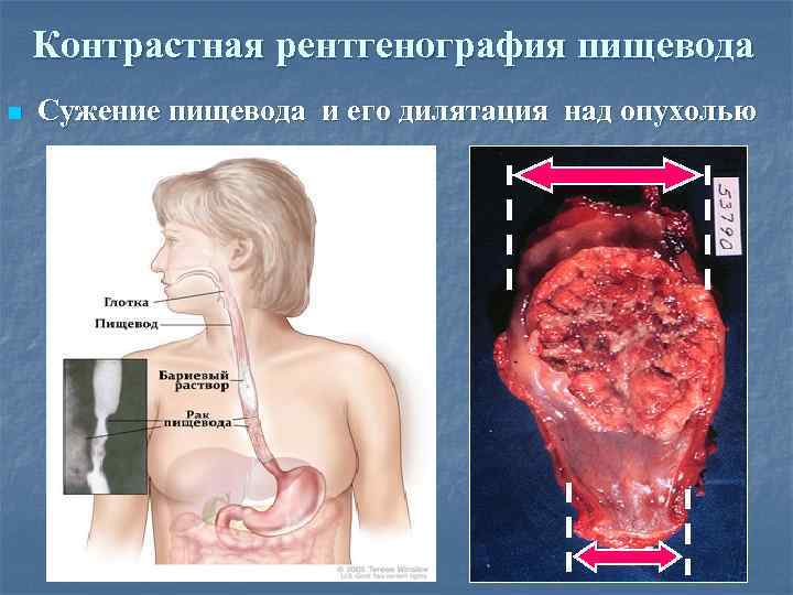 Контрастная рентгенография пищевода n Сужение пищевода и его дилятация над опухолью 