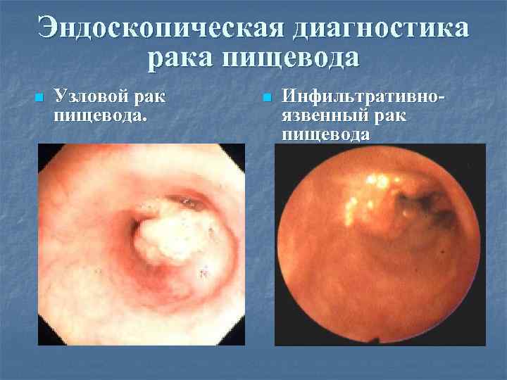 Эндоскопическая диагностика рака пищевода n Узловой рак пищевода. n Инфильтративноязвенный рак пищевода 