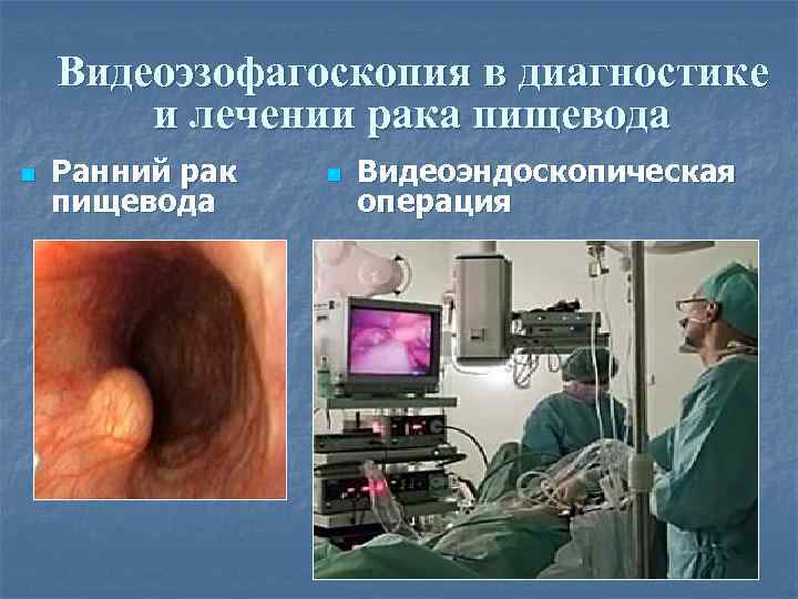 Видеоэзофагоскопия в диагностике и лечении рака пищевода n Ранний рак пищевода n Видеоэндоскопическая операция