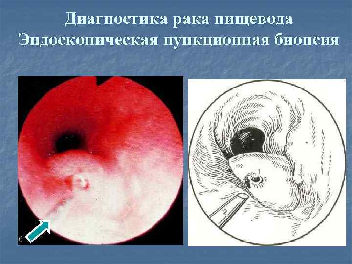 Диагностика рака пищевода Эндоскопическая пункционная биопсия 