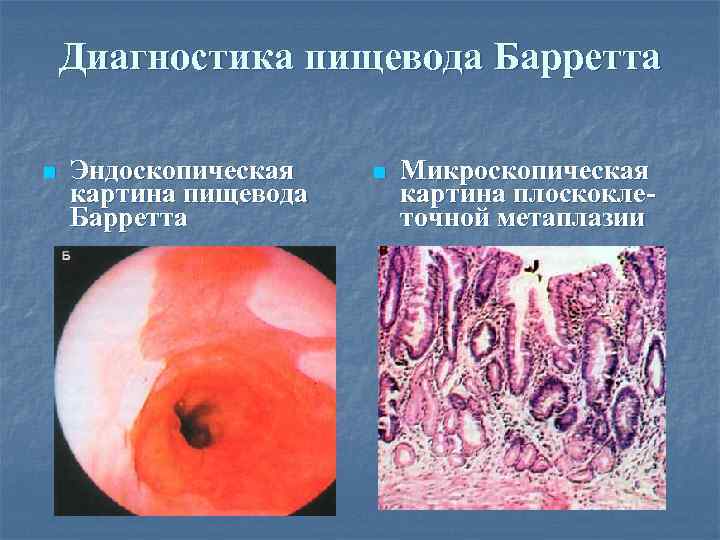 Диагностика пищевода Барретта n Эндоскопическая картина пищевода Барретта n Микроскопическая картина плоскоклеточной метаплазии 