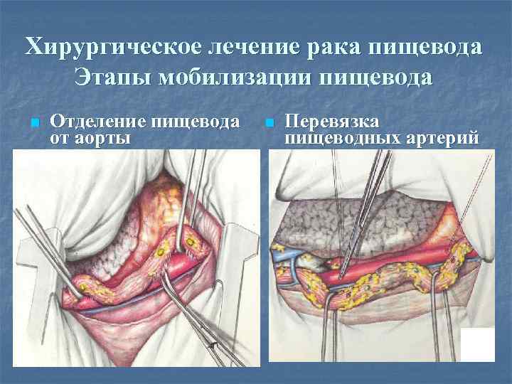 Хирургическое лечение рака пищевода Этапы мобилизации пищевода n Отделение пищевода от аорты n Перевязка