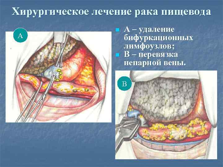 Хирургическое лечение рака пищевода А n n А – удаление бифуркационных лимфоузлов; В –
